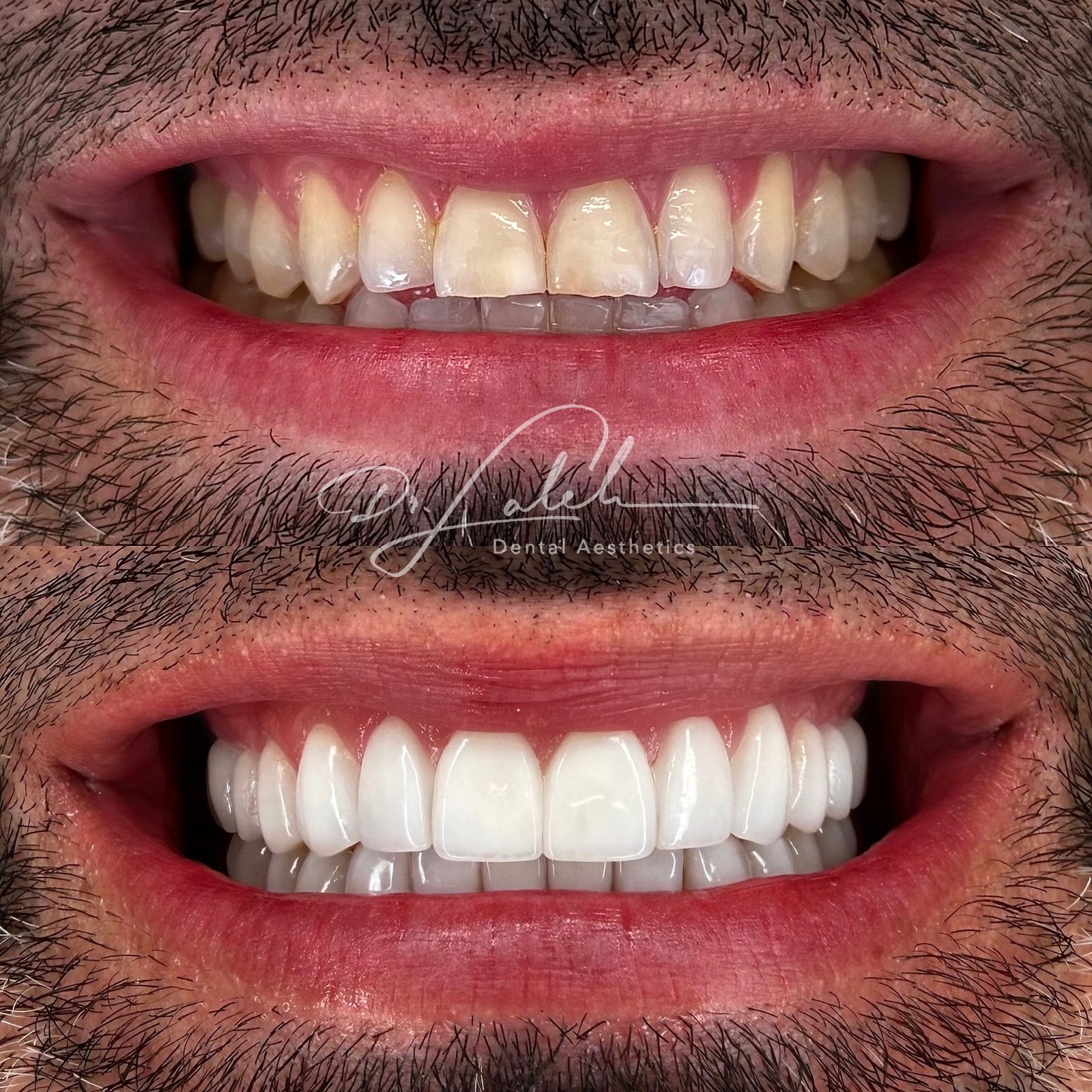 Smile transformation case 003 — before and after by Dr. Laleh Mehrrafiee, DDS