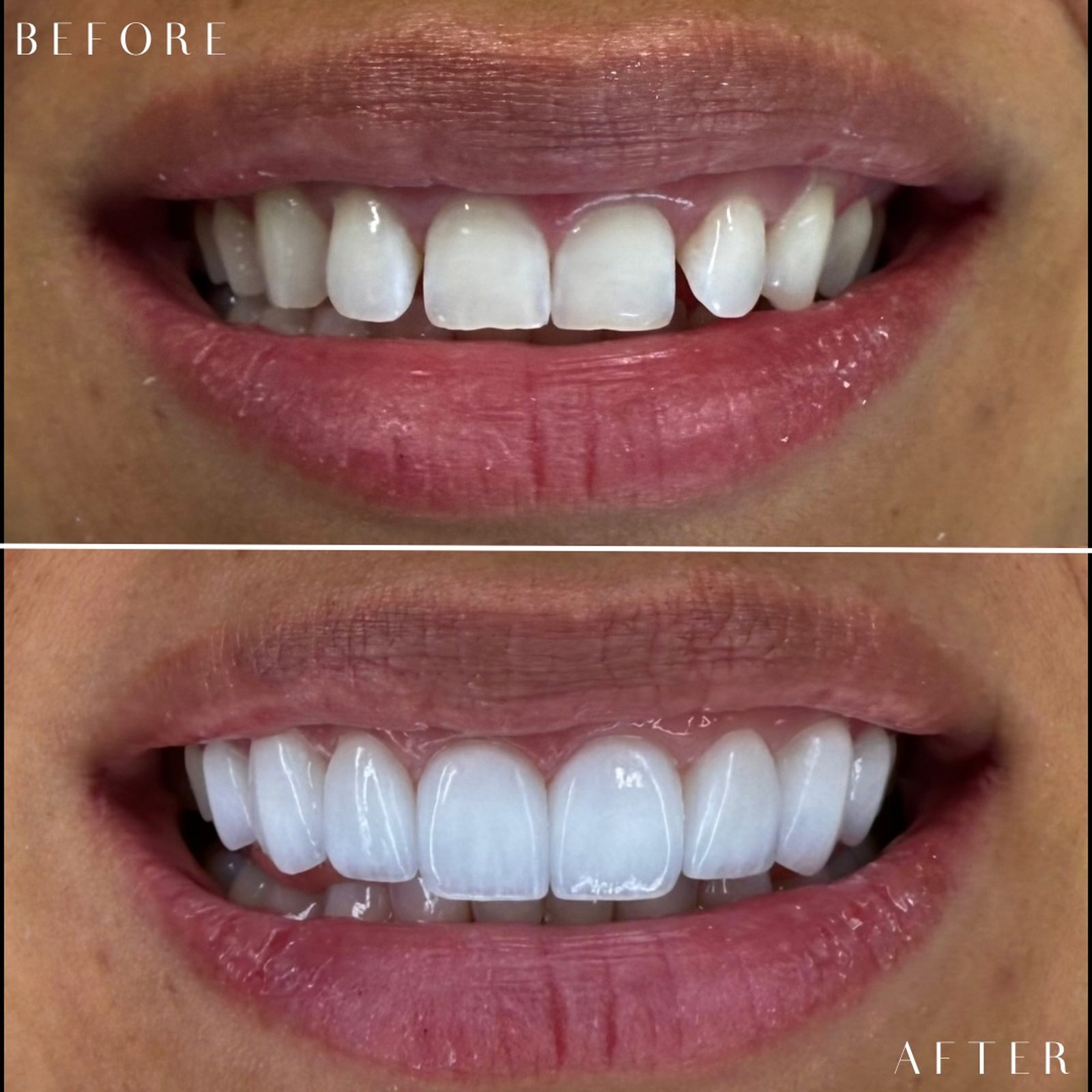 Smile transformation case 005 — before and after by Dr. Laleh Mehrrafiee, DDS