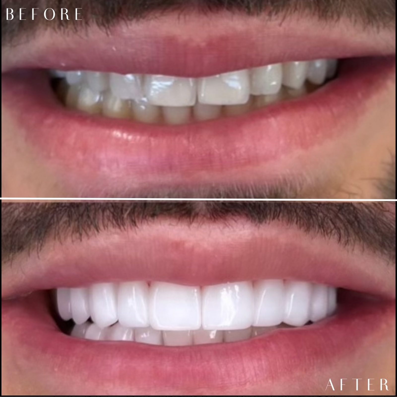 Smile transformation case 007 — before and after by Dr. Laleh Mehrrafiee, DDS