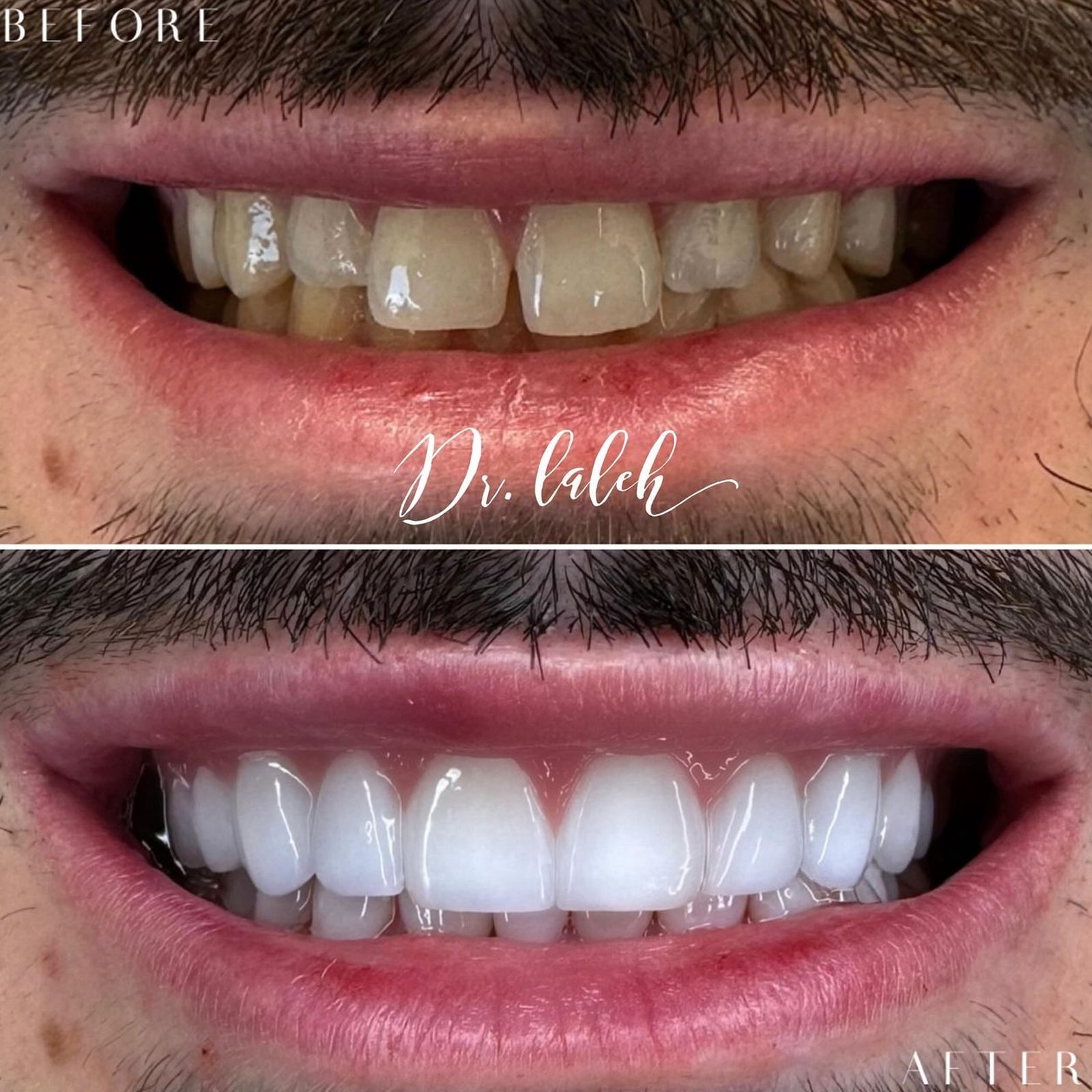 Smile transformation case 010 — before and after by Dr. Laleh Mehrrafiee, DDS