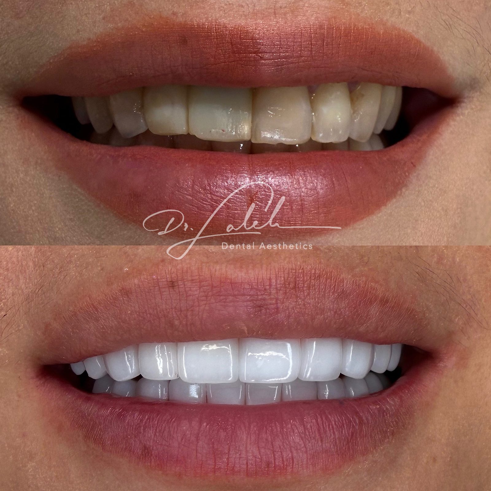 Smile transformation case 014 — before and after by Dr. Laleh Mehrrafiee, DDS