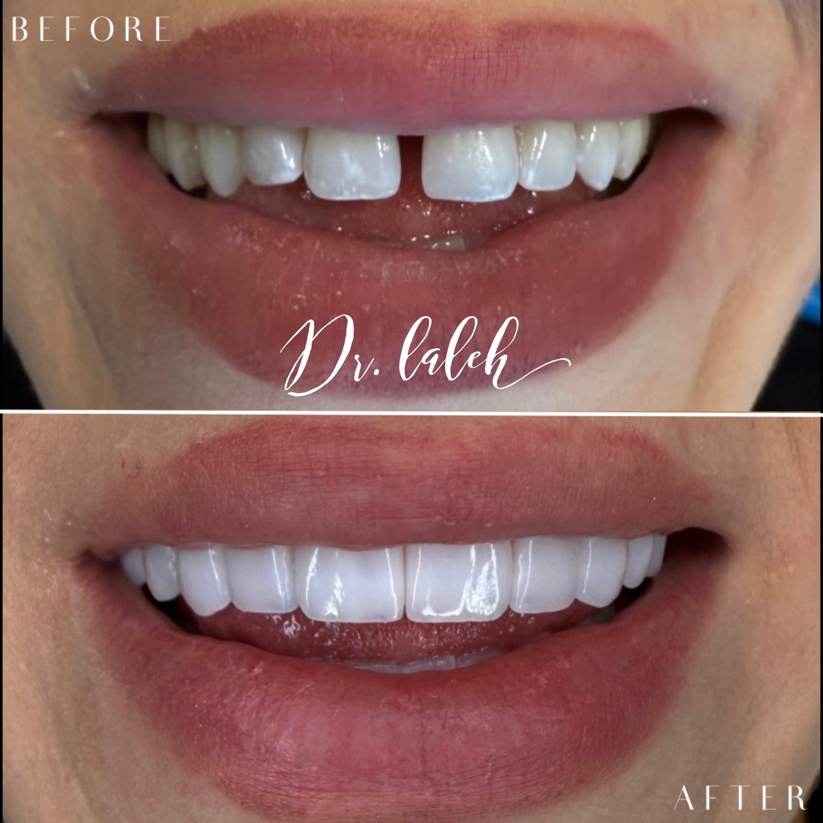 Smile transformation case 015 — before and after by Dr. Laleh Mehrrafiee, DDS