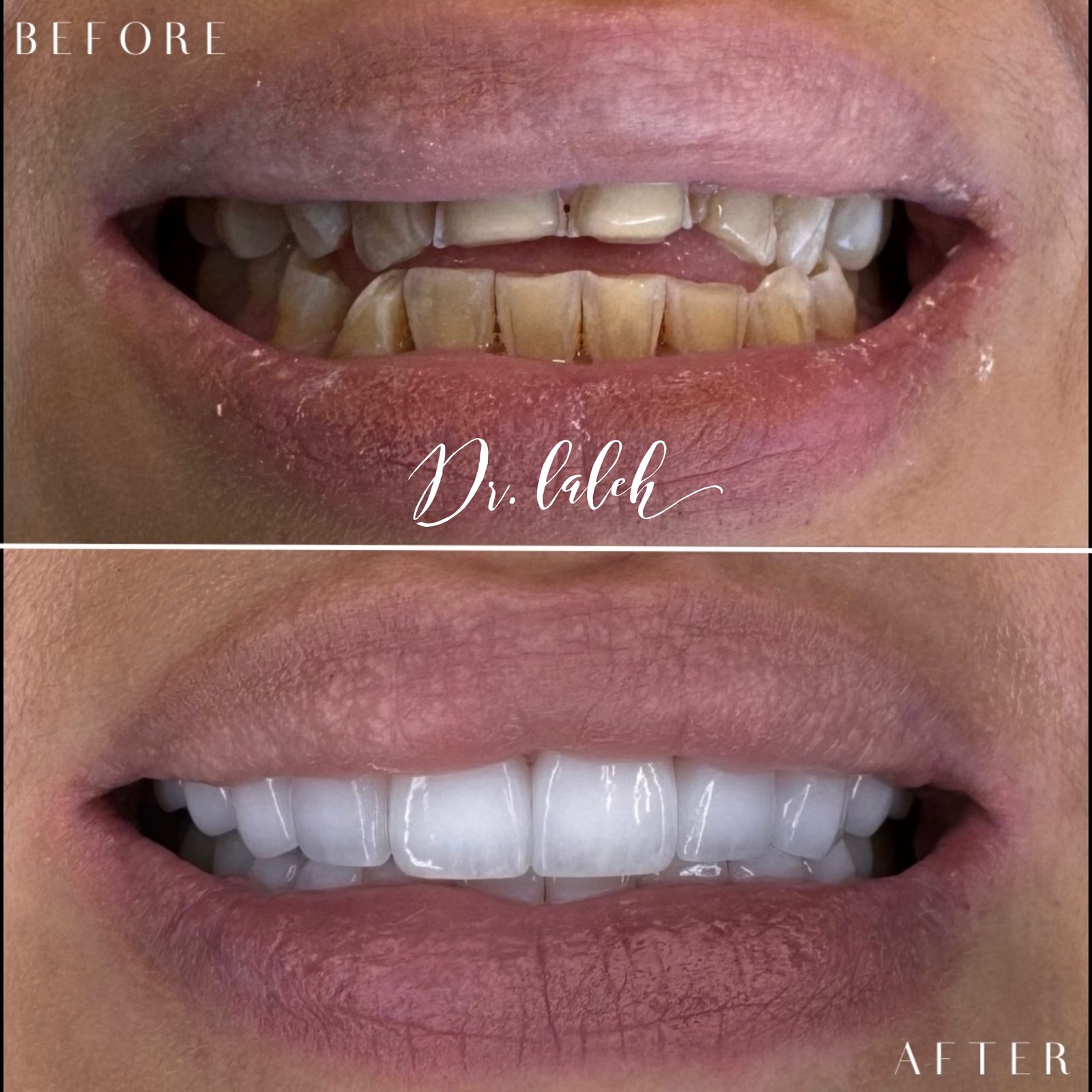 Smile transformation case 016 — before and after by Dr. Laleh Mehrrafiee, DDS