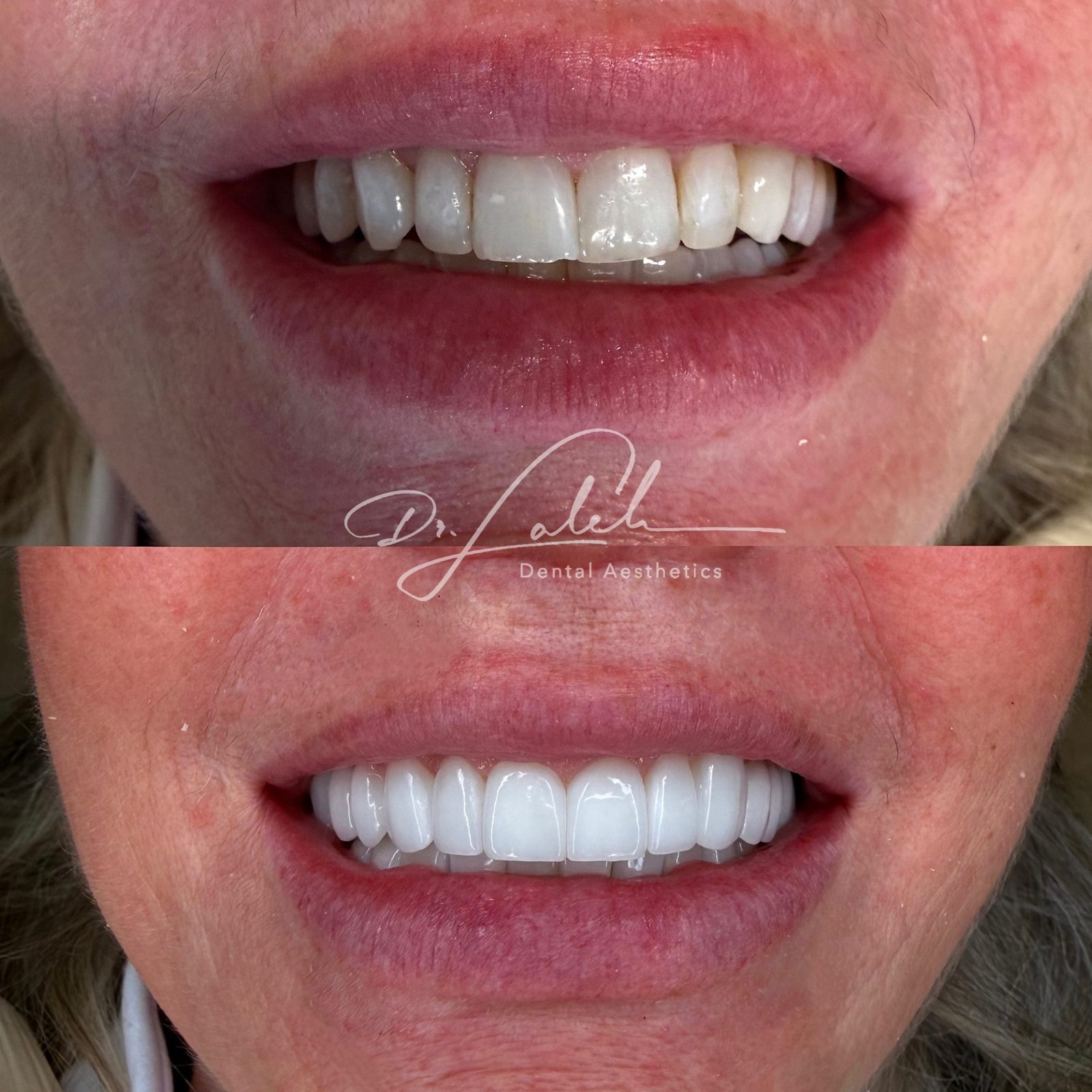 Smile transformation case 017 — before and after by Dr. Laleh Mehrrafiee, DDS