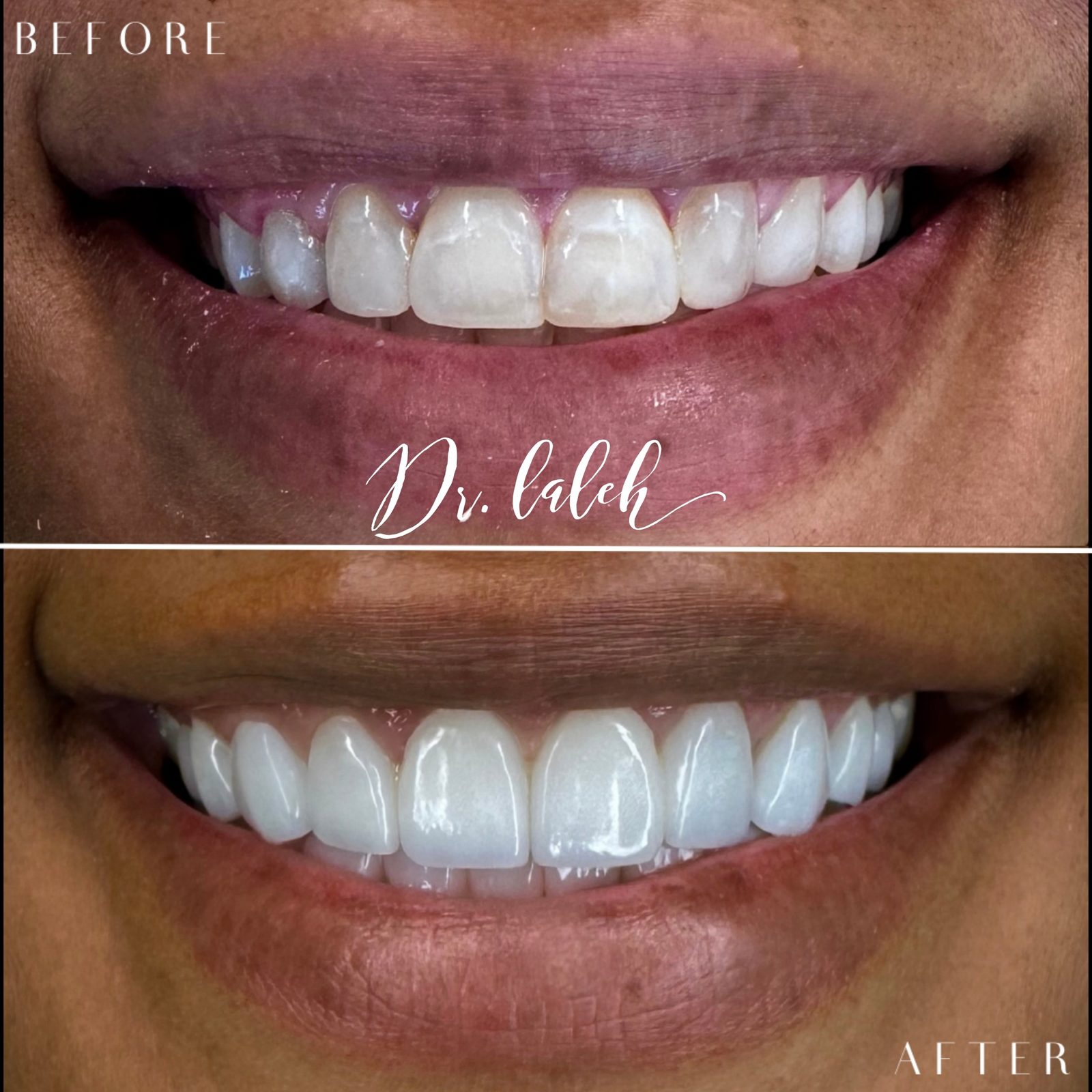 Smile transformation case 018 — before and after by Dr. Laleh Mehrrafiee, DDS