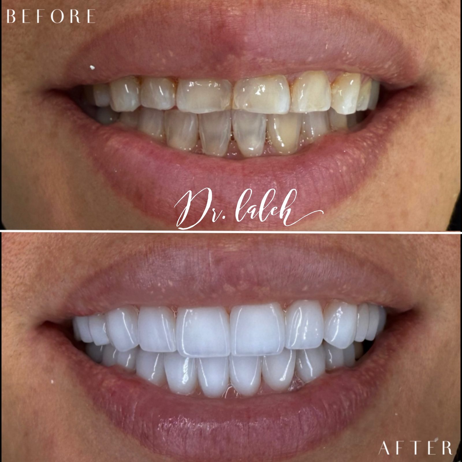 Smile transformation case 019 — before and after by Dr. Laleh Mehrrafiee, DDS
