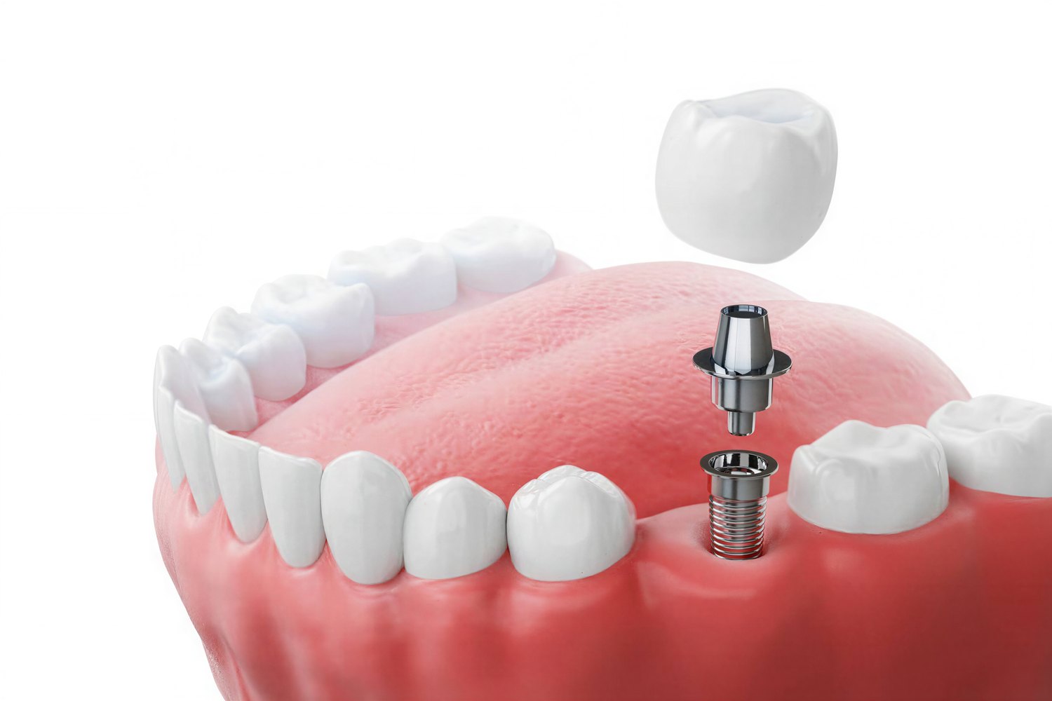 Dental implant model showing the crown, abutment and titanium post
