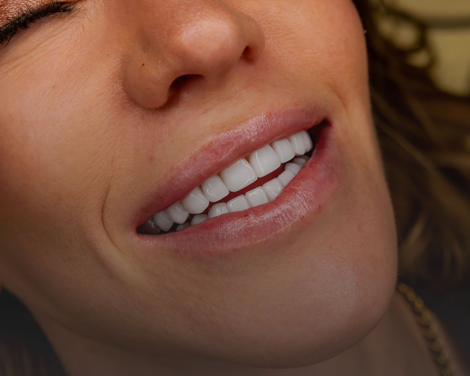 Close-up of a natural no-prep porcelain veneer smile by Dr. Laleh Mehrrafiee, DDS