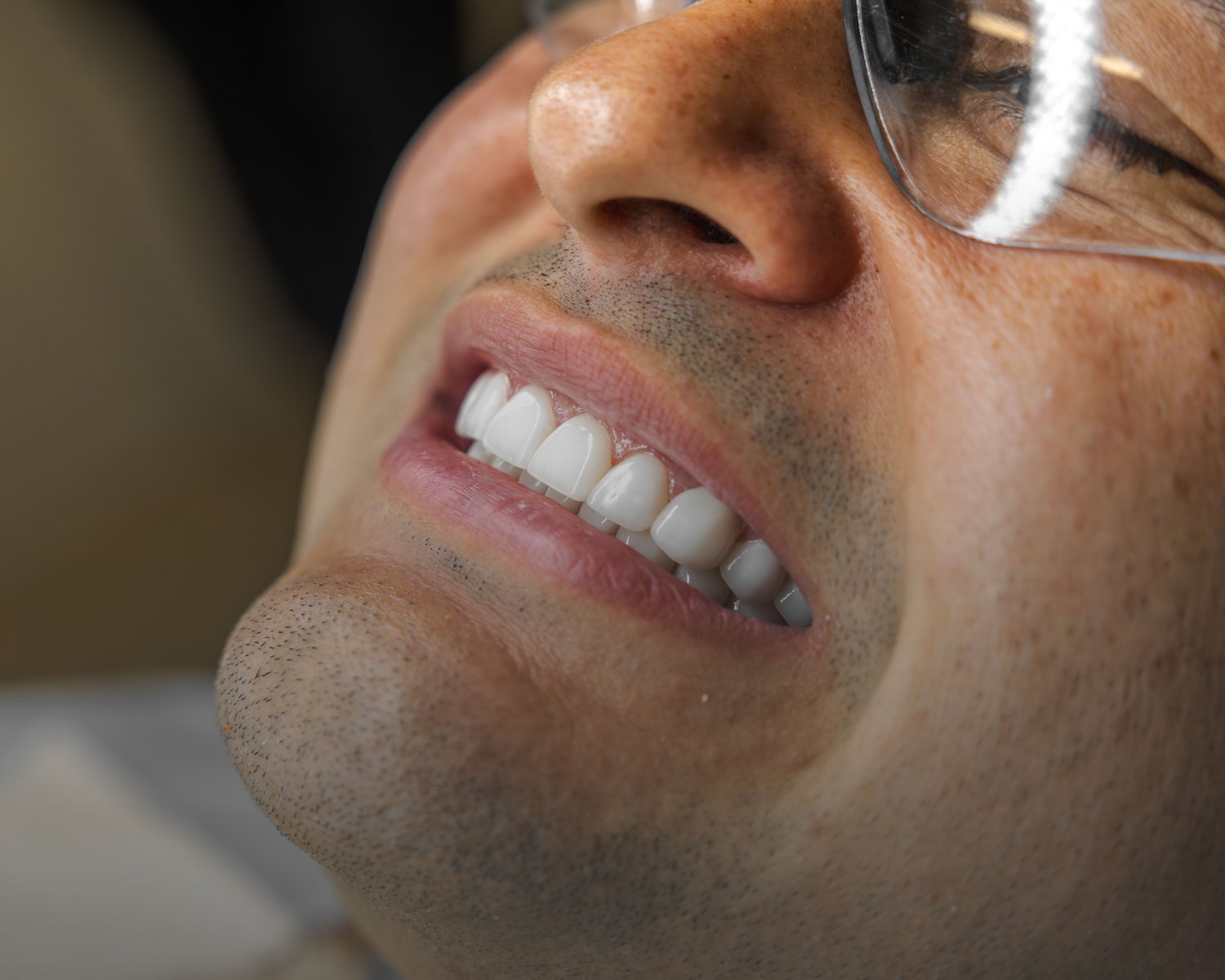 Refining porcelain veneers during a veneer revision at Doctor Laleh Dental Aesthetics